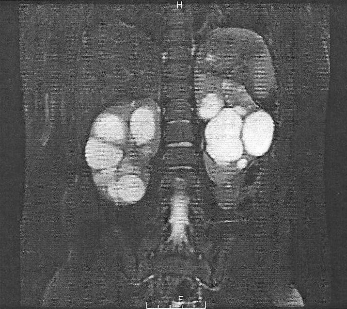 2011 kidneys